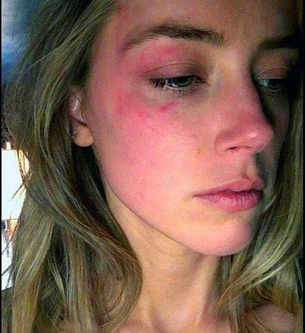 Bugün ise ortaya enteresan bir iddia daha atıldı. Amber Heard davanın başından beri Depp'in kendisine fiziksel şiddet uyguladığını belirtiyordu.