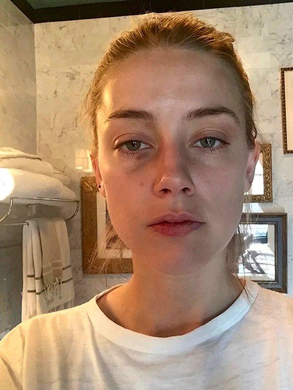 Aynı zamanda Johnny Depp'in kendisine telefon fırlattığını, bu telefonun ise yüzüne gelerek burnunu kırdığını belirtmişti. Fakat Amber Heard'ün herhangi bir doktora burun kırığı tedavisi için başvurmadığı ortaya çıktı.