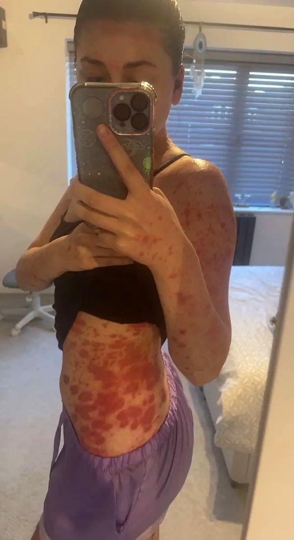 21 yaşındaki drama öğrencisi cildinde küçük, kırmızı ve pullu yaralar fark edip doktora gitti ve bir tür sedef hastalığı teşhisi kondu.