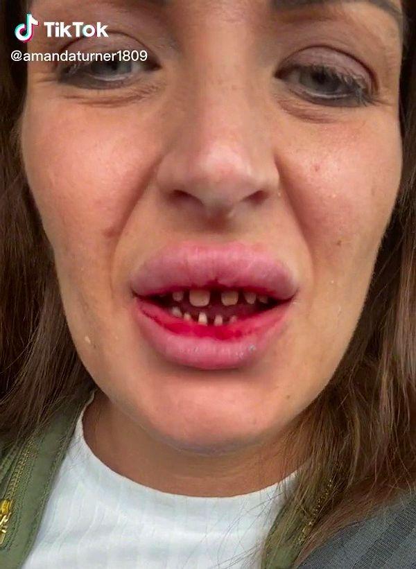 Türkiye'deki dişçinin yardım edip edemeyeceğini soran kullanıcılara Amanda, işlem prosedüründen şikayet ettiğinde kendisine çok kötü davrandıkları için onlardan "asla yardım beklemediğini" söyledi.