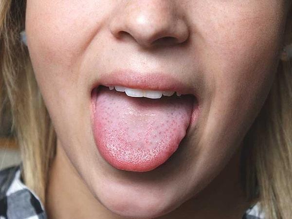 Dildeki renk ve şekil değişikliği vücuttaki vitamin ve besin eksikliğini gösterir.