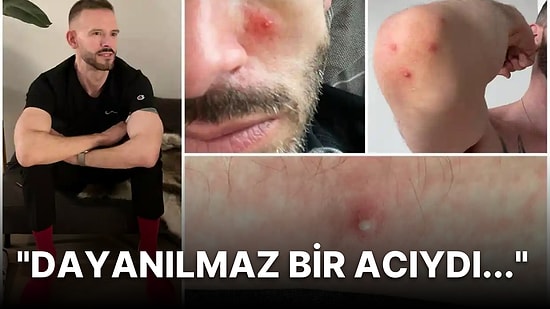 "Kabus Gibiydi": Maymun Çiçeği Virüsüne Yakalanan Adam Hastalık Sürecinde Yaşadıklarını Teker Teker Anlattı!