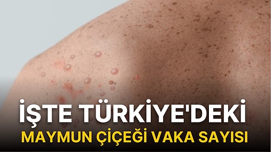 İşte Türkiye'deki Maymun Çiçeği Vaka Sayısı