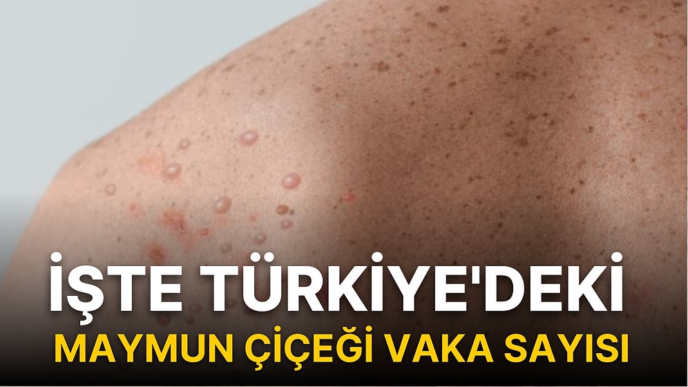 İşte Türkiye'deki Maymun Çiçeği Vaka Sayısı