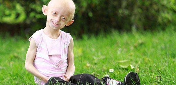 Progeria: Erken yaşlanma hastalığı