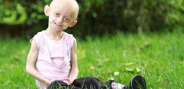 Progeria: erken yaşlanma hastalığı