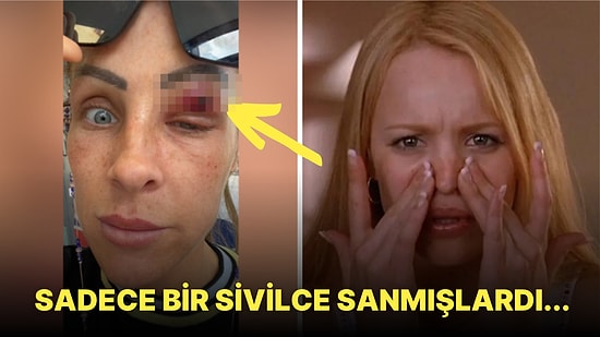 Uyandığında Göz Kapağında Tuhaf Bir Şişlikle Karşılaşan Kadının Uzaylı Filmlerini Anımsatan Hikayesi