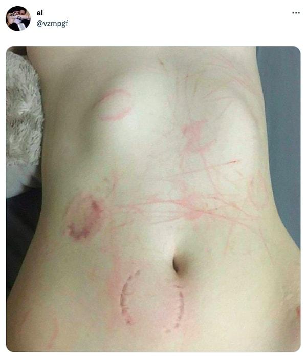 Twitter'da bir kullanıcı da tam olarak bunu yaşamış ve ilişki sonrası ısırıklarla dolu vücudunun fotoğrafını paylaştı...