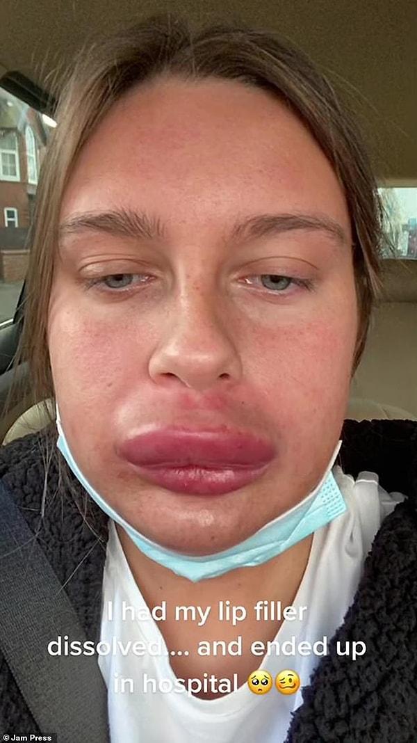 Newcastle-upon-Tyne'den Ruby isimli bir kadın, yaptırdığı dudak dolgusunu beğenmeyince düzelttirmek için bir kliniğe gitti.
