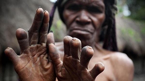 9. Papua Yeni Gine'de kadınlar sevdikleri ölünce parmaklarını kesiyordu.