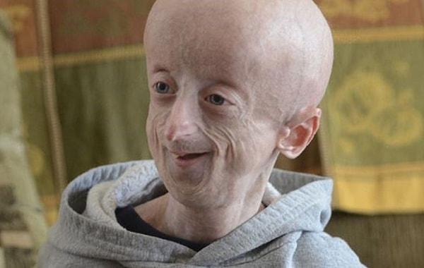 7. Hutchinson-Gilford Progeria Sendromu