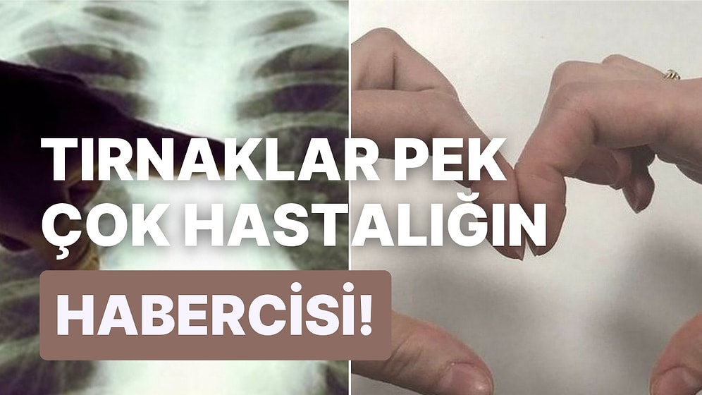 Akciğer Kanserinin Habercisi Olabilir! Çomak Parmak Nedir ve Belirtileri Nelerdir?