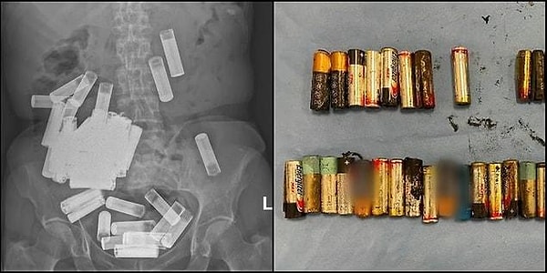 8. İrlanda'da bir kadının hem midesinden hem de anüsünde 55 adet pil çıkarıldı.