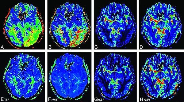 Vücuttaki fizyolojik süreçleri gösteren PET ve beyin fonksiyonlarını incelemeye yarayan fMRI taramaları ile yapılan deneyler, en basit hareketimizde bile beynin tümünün çalıştığını gösteriyor.