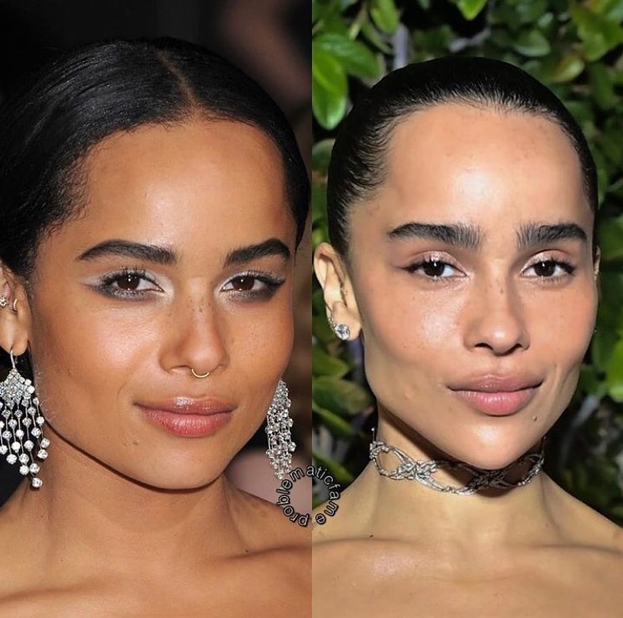 Son Yılların Jawline Estetik Modasını İyice Abartıp Yüz Hatlarını