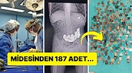 Karın Ağrısı Şikayetiyle Hastaneye Kaldırılan Adamın Midesinden Çıkanlara İnanamayacaksınız!