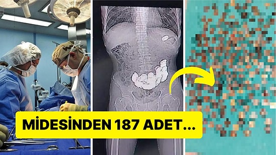Karın Ağrısı Şikayetiyle Hastaneye Kaldırılan Adamın Midesinden Çıkanlara İnanamayacaksınız!