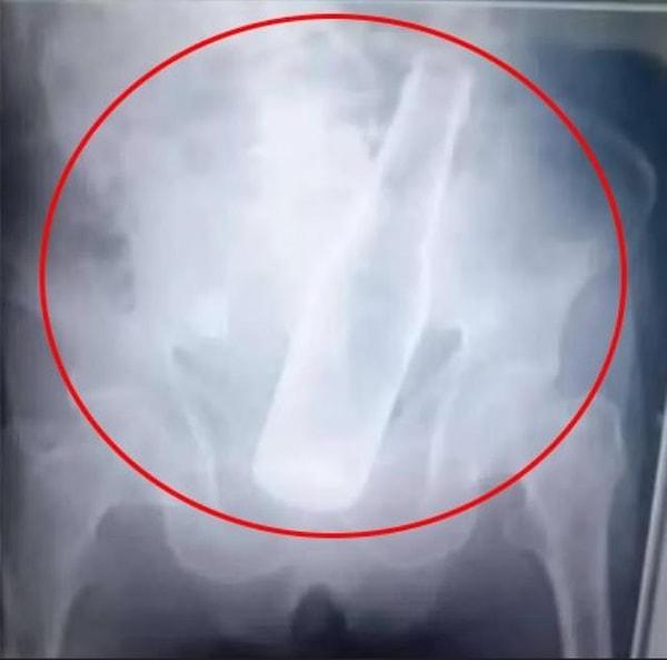 Doktorlar röntgen görüntüleri karşısında oldukça şaşırdılar çünkü hastanın makatında bir bira şişesi vardı. Hastayı hızlı bir şekilde ameliyata aldılar ve şişeyi çıkarttılar.