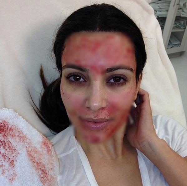 Hatırlarsanız geçtiğimiz senelerde Kim Kardashian da ‘vampir cilt bakımı’ ismi verilen yönteme başvurarak kendi kanını yüzüne enjekte ettirmiş ve fotoğrafını Instagram’da paylaşarak popülerleşmesine neden olmuştu.
