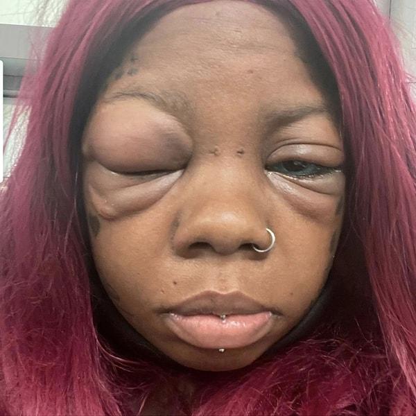Aralık ayında sol gözüne de dövme yaptırmaya karar veren talihsiz kadın, aşırı şişkin gözleriyle uyanınca acile gitti.