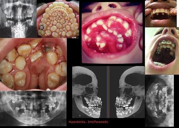 17. Çenesinden normalden fazla sayıda diş bulunan 'Hyperdontia' sahibi insanların görüntüleri... 😱