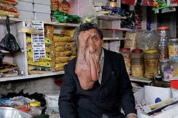 Hindistan'da bir adam, yüzünün eriyormuş gibi görünmesine neden olan nadir bir rahatsızlık nedeniyle sürekli olarak insanların bakışlarına maruz kalıyor.