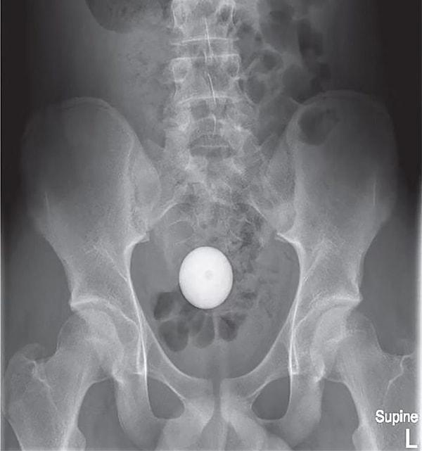 Röntgen filminde beyaz, yuvarlak yumurta gibi gözüken işimin aslında golf topu olduğu ortaya çıktı.
