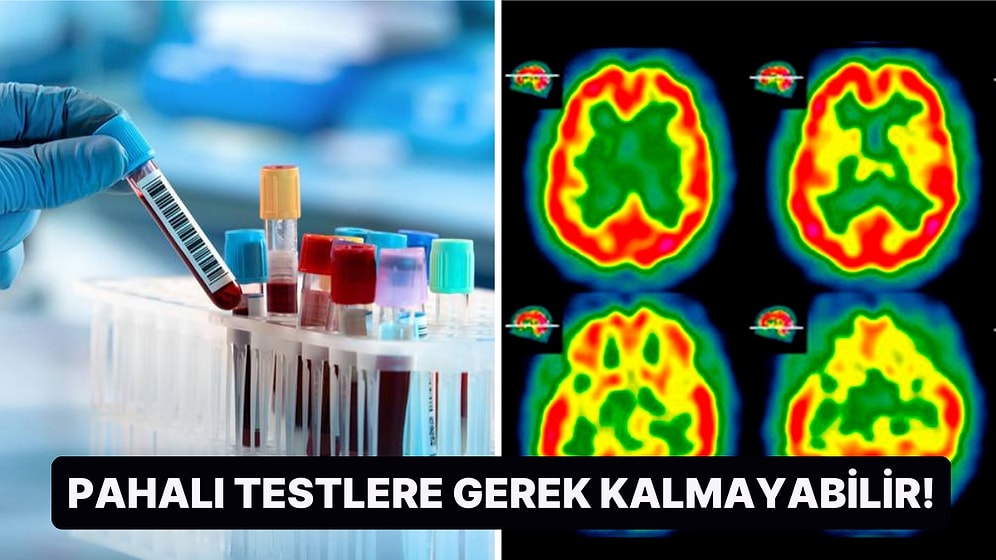 Pahalı Taramalara İhtiyaç Duymadan Alzheimer Hastalığını Tespit Edebilecek Yeni Bir Kan Testi Bulundu!