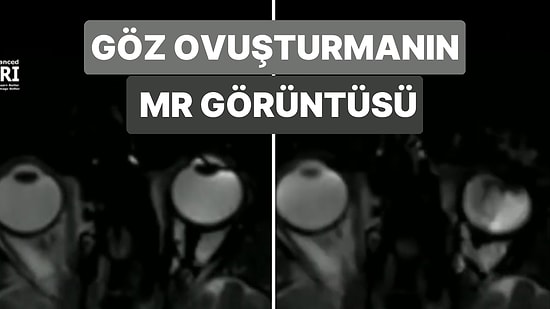 Göz Ovuşturmak MR Cihazında Nasıl Gözükür?