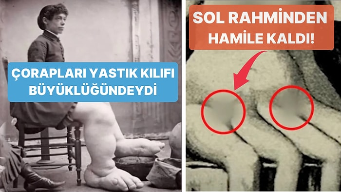 Farklılıkları Yüzünden İnsanların Önünde Sergilenen 'Sirk Ucubelerinin' Dramatik Hayat Hikayeleri