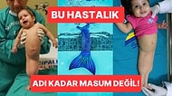Vakalar 24 Saat İçerisinde Hayatını Kaybediyor! Dünyanın En Nadir Görülen Sendromu: Sirenomeli Deniz Kızı