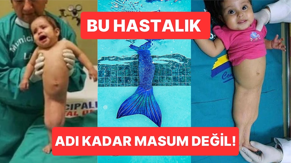 Vakalar 24 Saat İçerisinde Hayatını Kaybediyor! Dünyanın En Nadir Görülen Sendromu: Sirenomeli Deniz Kızı