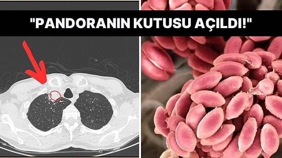 Dünyada İlk Kez Görülen Bir Enfeksiyona Yakalanan Adam, Tıp Dünyasını Gelecek Vakalar Konusunda Endişelendirdi