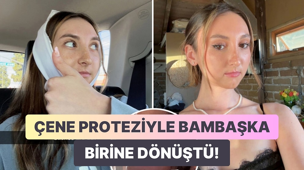 Sincaba Benzetilip Zorbalığa Uğrayan ve 4 Milyon TL'lik Çene Protezi Yaptıran Kadının İnanılmaz Değişimi