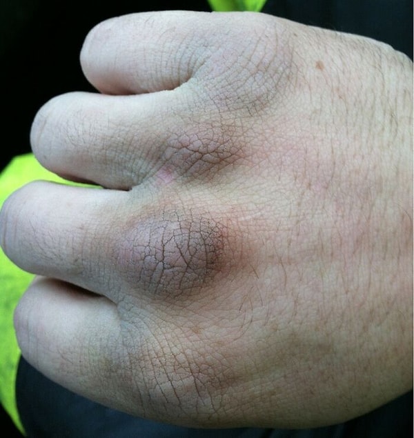 49. «Будьте добры к своему мусорщику особенно, когда идет дождь, а на улице 30 градусов. Мы не непобедимы. Это моя рука после 4 часов работы в такую погоду»