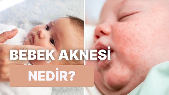 Her Bebekte Görülebilen Beyaz İrinli Akneler Nedir?