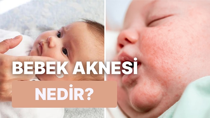 Her Bebekte Görülebilen Beyaz İrinli Akneler Nedir?