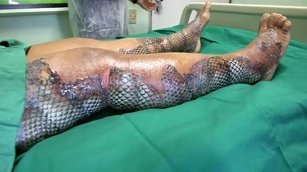 Her şey Brezilya'da yüzü, kolları ve boynu ikinci derece yanık olan bir kadının hastaneye başvurması ile başladı.