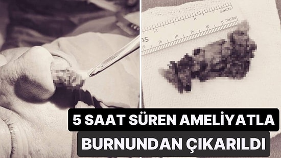 50 Yaşındaki Hastanın Burnundan 8 Santimetrelik Kitle Çıkarıldı