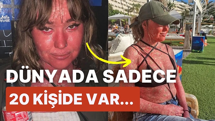 Son Derece Nadir Bir Hastalığa Sahip Olduğu İçin Cildi Pul Pul Dökülen Kadının Hikayesi