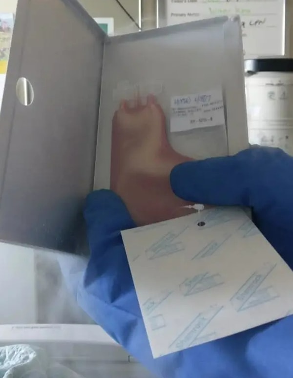 15. Вот как выглядят стволовые клетки после того, как их собрали и подготовили к пересадке: