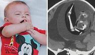 В черепе годовалой девочки обнаружили «нерожденного близнеца-паразита»