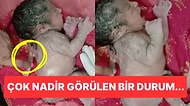 Hindistan'da Bir Bebek Sırtında Fazladan Bir Kolla Dünyaya Geldi!