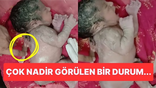 Hindistan'da Bir Bebek Sırtında Fazladan Bir Kolla Dünyaya Geldi!