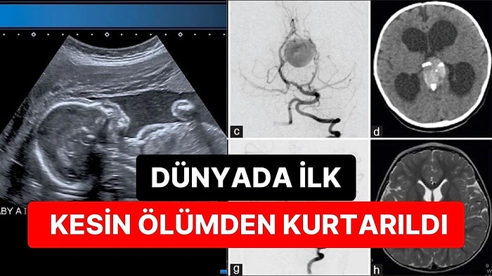 Dünyada İlk: Anne Karnındaki Bebeğe Beyin Ameliyatı Yapıldı