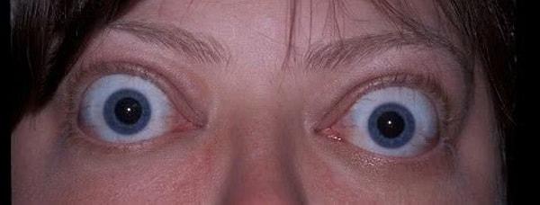 Graves oftalmopatisi neden olur?