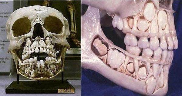 11. Süt dişleri dökülmeden önce bir çocuğun kafatası böyle gözükür 👇