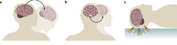 12. Küçük bir beyin travmasıyla bile beyniniz sıfırlanabilir.
