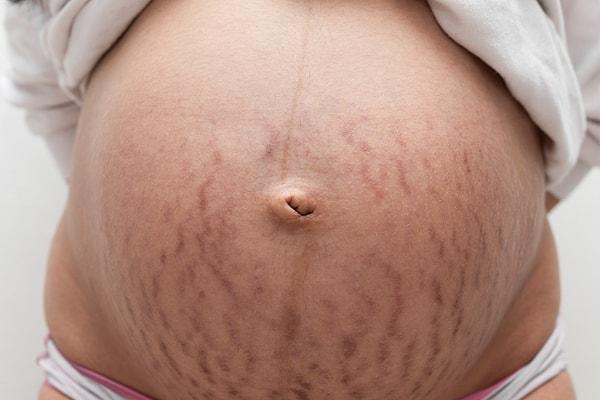 Çatlaklar hamilelik sırasında en çok karşılaşılan cilt problemlerinden. Hamilelikte görülen hormon dalgalanmaları, kolajen ve elastin bağlarını zayıflatarak cilt hastalıklarına davetiye çıkarıyor.