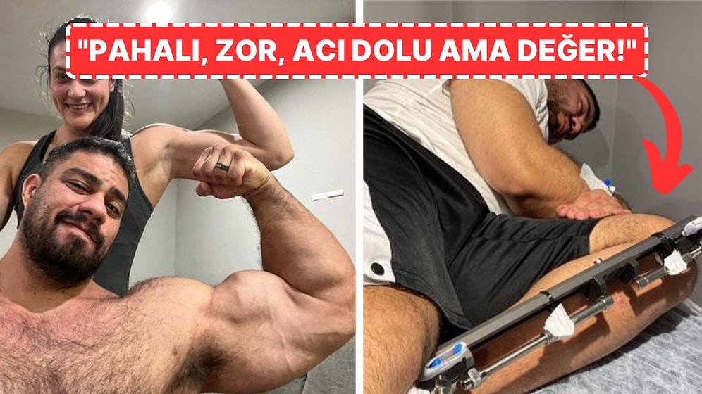 Boyunu Uzatmak İçin 100 Bin Dolar Harcayan Adamın Şoke Eden Açıklamaları: "Kayınçom Benden Uzundu!"